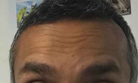 forehead-lines