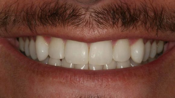 composite-bonding-at-dentist-in-farnham