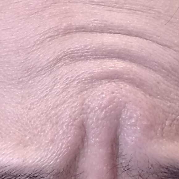 Wrinkle Reduction in Camberley & Godalming